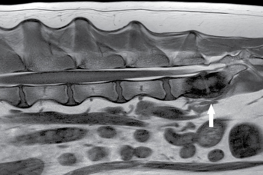 Discospondylitis